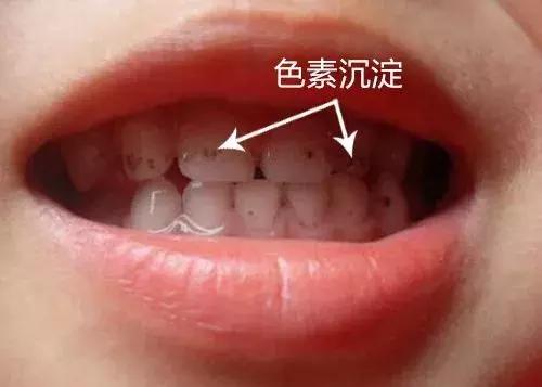 牙齿上的黑点污垢怎么能够清理掉,孩子牙齿上有黑色的斑怎么去除