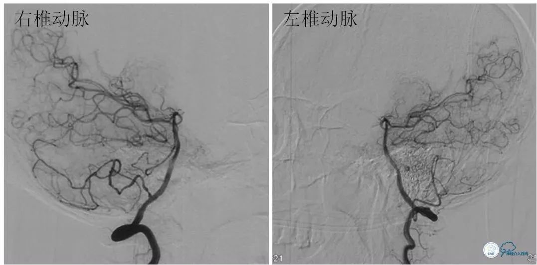 颈内动脉c5到c7段狭窄微创手术,天坛医院住院日记