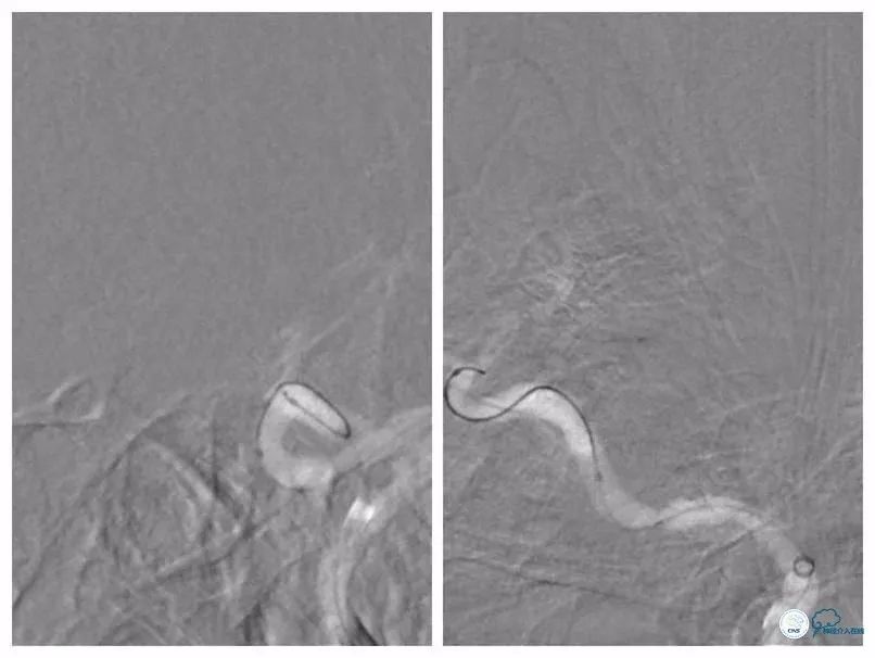 颈内动脉c5到c7段狭窄微创手术,天坛医院住院日记
