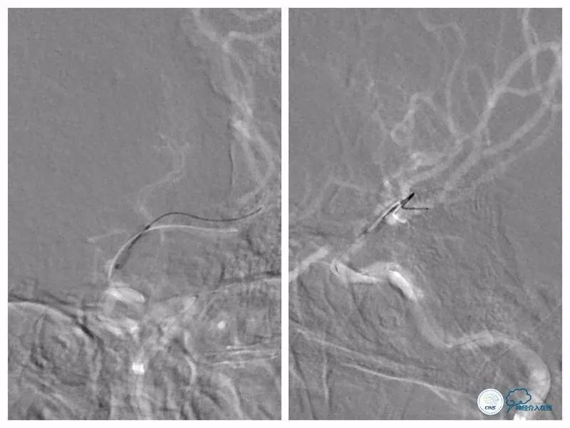 天坛医院住院日记,颈内动脉c5到c7段狭窄微创手术
