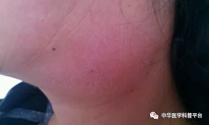 淋巴结注意事项有哪些,有关淋巴结的相关知识