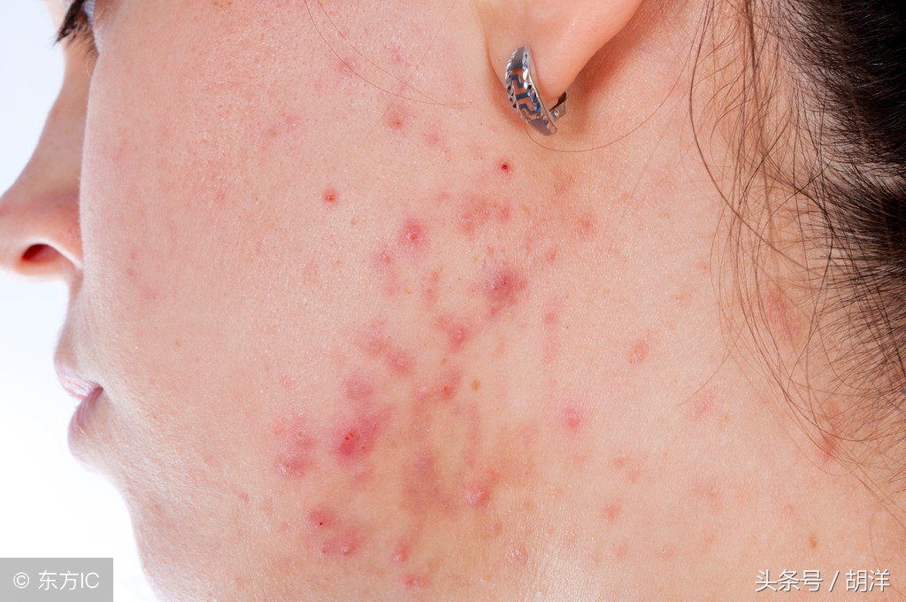 妇科真菌感染的克星,厌氧菌感染妇科怎么治疗