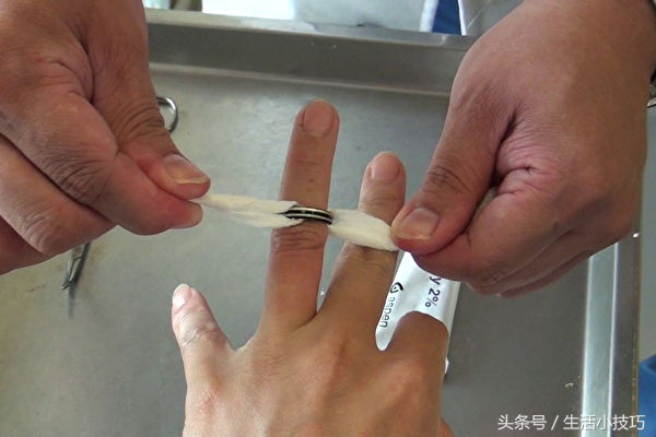 戒指卡住手指怎么办？医师1招轻松取下
