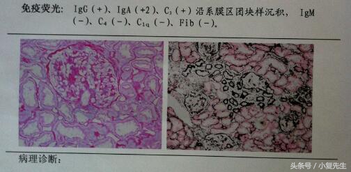 肾病综合征要怎么休息,得了肾病为什么需要静养
