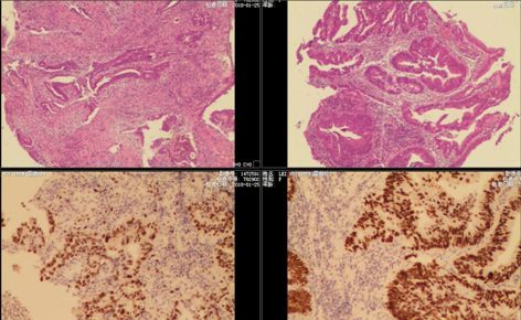 容易便血的痔是什么痔,便中带血是寄生虫吗