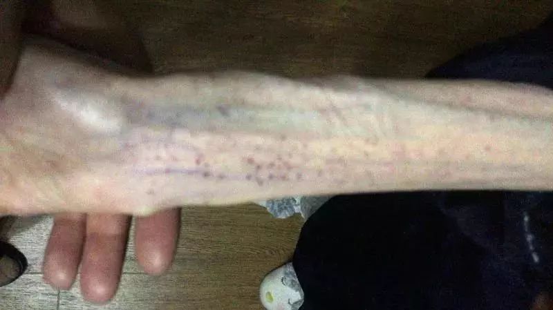 21岁女孩“自杀式减肥”,1米67只剩50斤!照片不忍直视……