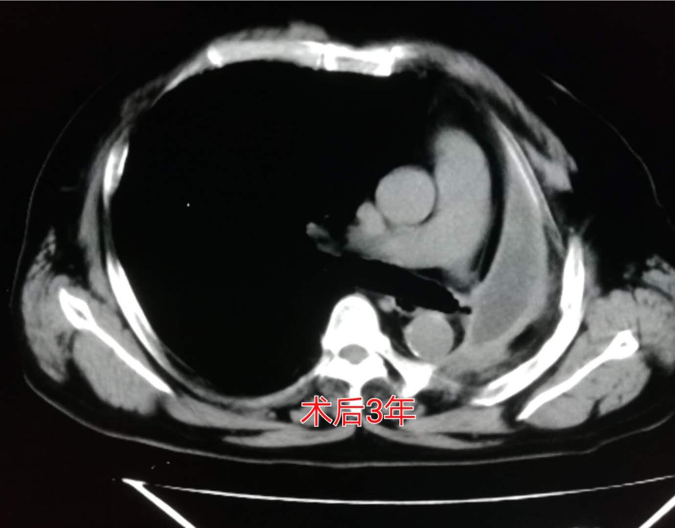 年轻人切除一个肾脏,切除一个肾脏手术全过程