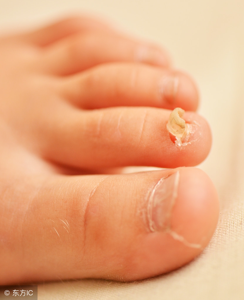 灰指甲怎么看,得了灰指甲怎么办这个方法告诉你