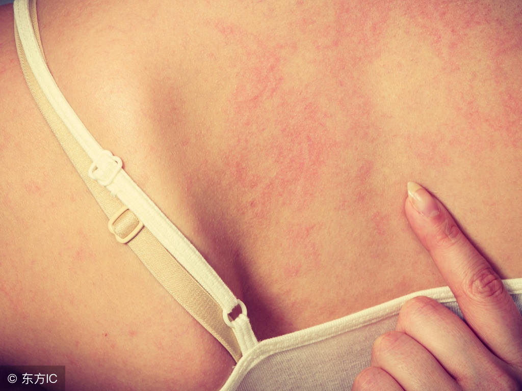 山药是发物吗湿疹患者能吃吗,湿疹患者可以吃芹菜吗