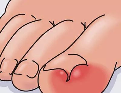 指甲往肉里长使用矫正器有效吗,解决指甲往肉里长的方法