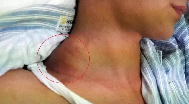 20岁小伙被诊断癌症,小伙25岁查出肝癌