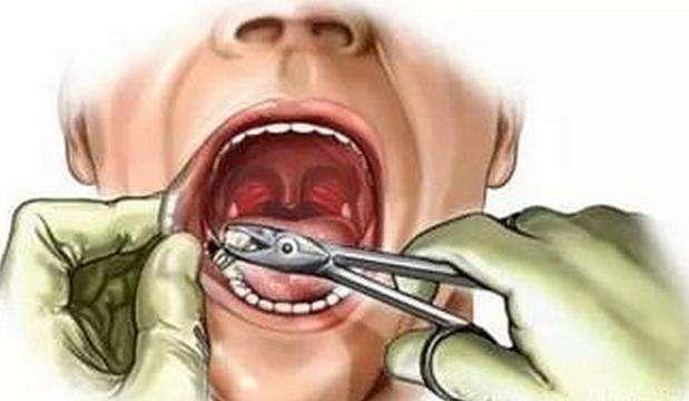 超实用的拔牙小技巧有哪些,拔牙知识图片
