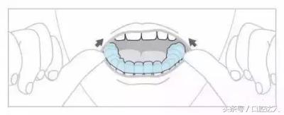 隐形牙套佩戴注意事项,替牙期隐形牙套佩戴管理