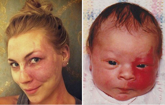 什么情况下胎儿脸上会长胎记,什么原因导致胎儿脸上有胎记