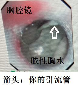 胸水抽了为什么还呼吸困难,胸水抽不出来了怎么回事
