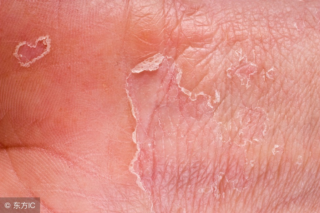 湿疹颜色变深褐色脱皮,手部湿疹脱皮怎么治疗