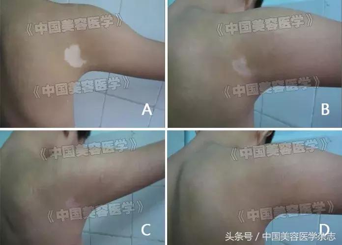 皮肤原位再生医疗技术联合微针导入治疗白癜风