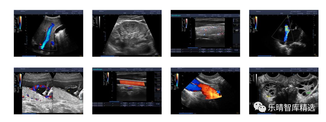 彩超发展到几代了,彩超技术发展史