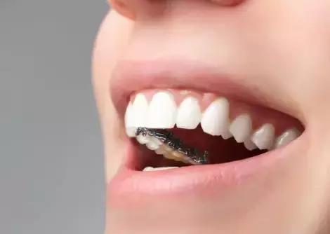 还在犹豫是否整牙，明星们默默变美都在靠它，你想知道的这篇都有