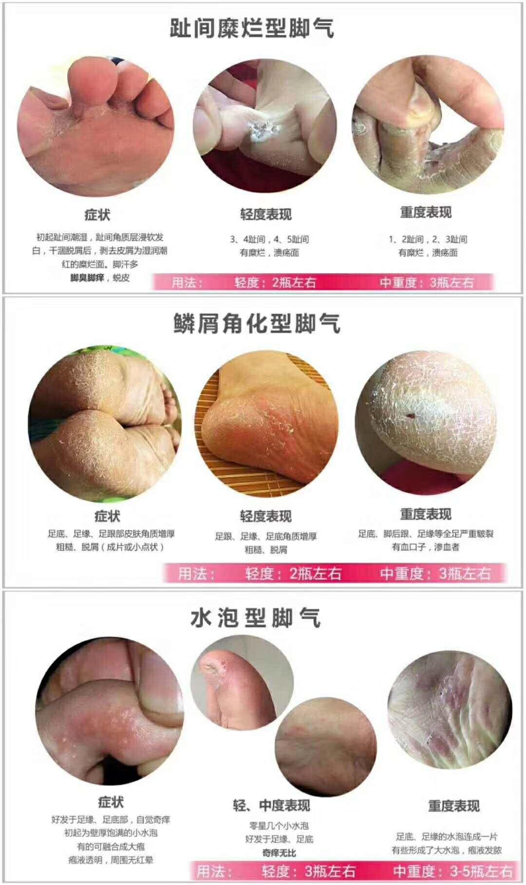 脚气擦什么药膏？医师完整解答脚气症状与治疗，让你远离香港脚