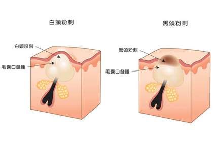 脸上的白头粉刺怎么去除简单方法,白头粉刺刺破变成红点