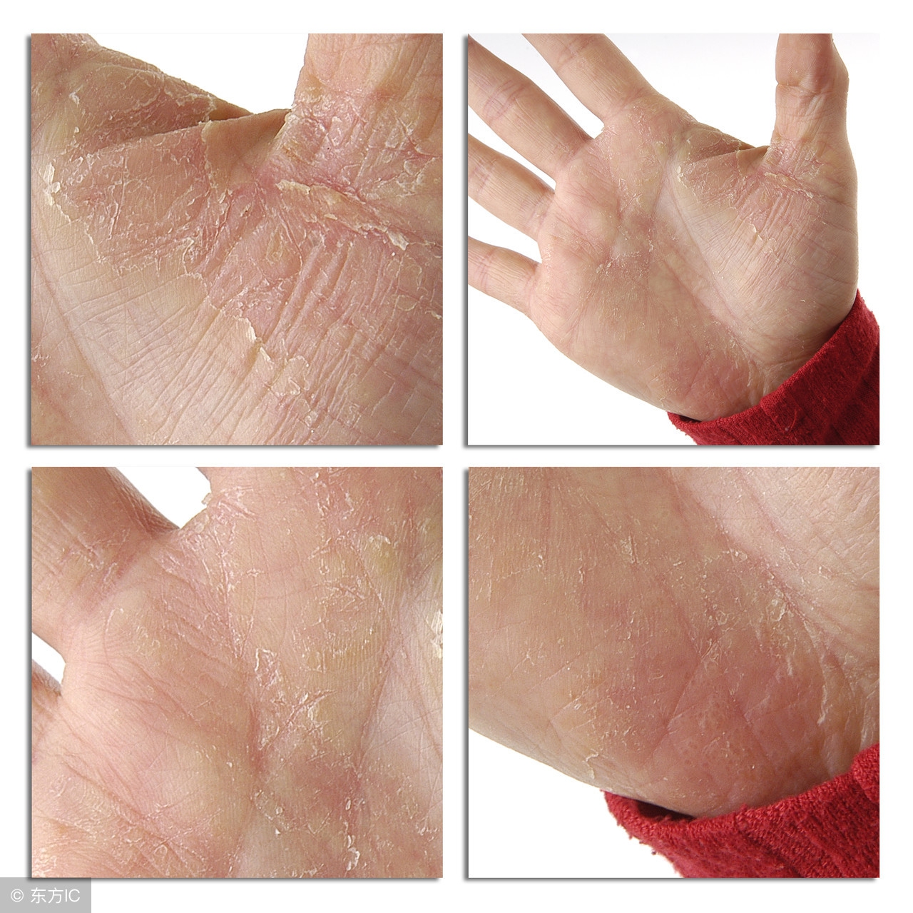 尖锐湿疣怎么来的，具体的病因是什么