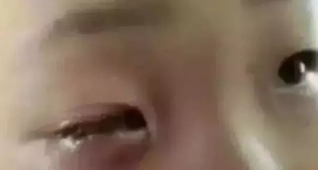 男孩眼珠融化的原因,孩子眼球融化的危害