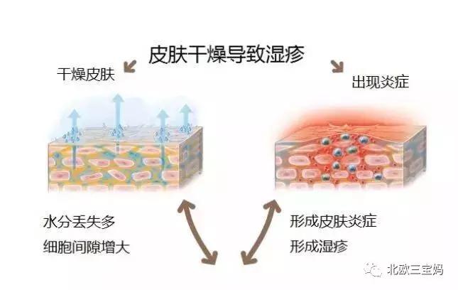 儿童急疹科普,宝宝湿疹和热疹的正确护理方法