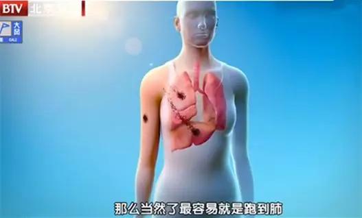 这四种痣会癌变赶紧来了解一下,这5种癌及早发现同样能治愈