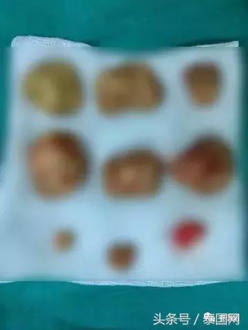 泰国女人打耳洞视频,泰国女子打耳洞