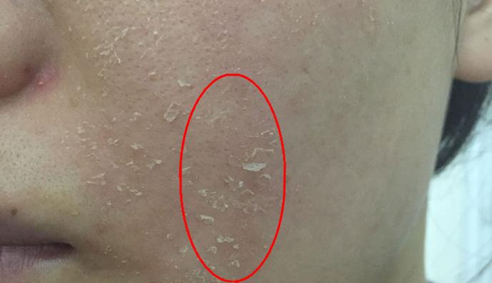 脸上螨虫很多用什么护肤品,脸上螨虫多除螨用什么药物