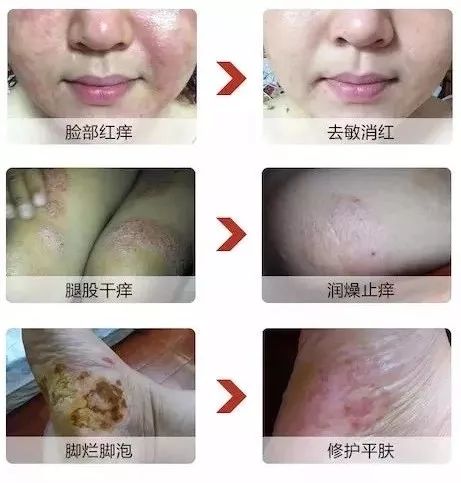 儿童鼻痒鼻塞鼻炎用什么喷剂,小孩鼻塞建议用什么鼻喷雾剂