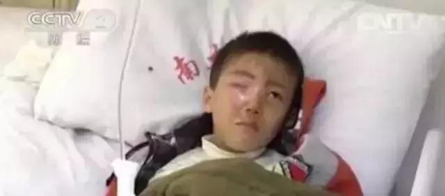 孩子右眼20分钟被融化,儿童眼球被溶化的原因