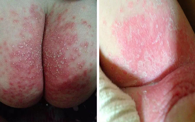 婴儿肌肤总有问题,远离宝宝肌肤问题