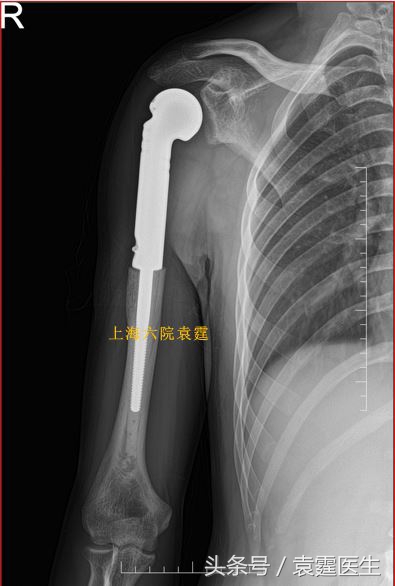 肩周肿瘤怎么治疗最好,肩痛患者诊治流程