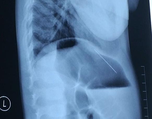 两岁半宝宝体内藏针,两岁儿童缝衣针