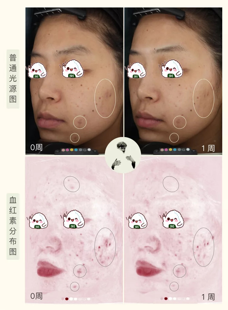 30天花80块去掉陈年老痘印到底有没有可能？