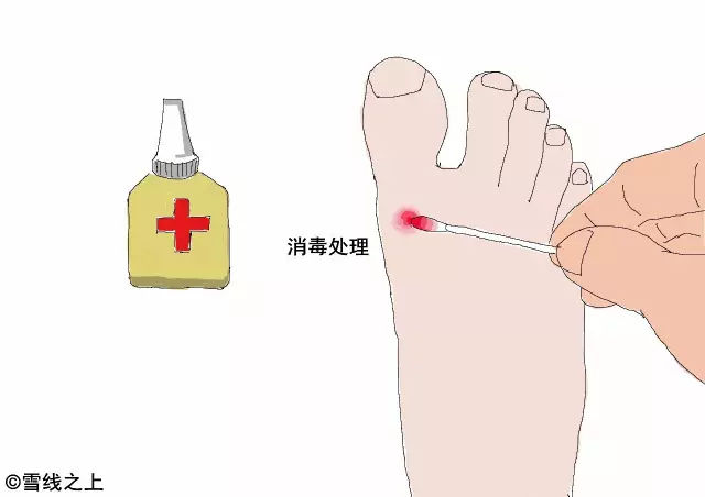 陶冶重庆｜徒步时，如何防治水泡？