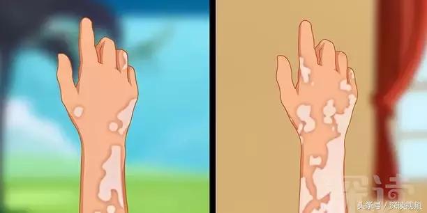 海边游泳晒红了怎么补救,海滩游泳后皮肤起红点