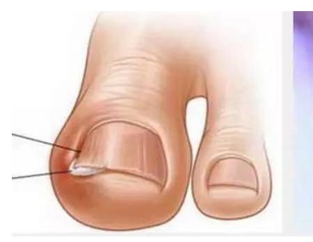 甲沟炎居然无需拔甲？这样治就能治好甲沟炎！