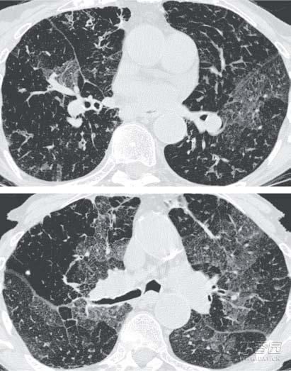 健康｜它比香烟毒7倍，国外已被禁，很多中国人却还在用！最新研究：它会导致基因变异，引起肺癌！