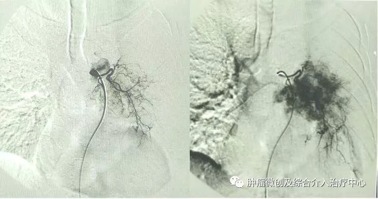 肺癌的诊断+综合介入治疗（穿刺活检+肿瘤血管栓塞+消融+碘125例子植入）—运城市第一医院肿瘤微创及综合介入科