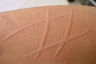 荨麻疹属于麻疹类型吗,得荨麻疹丘疹几天可以好