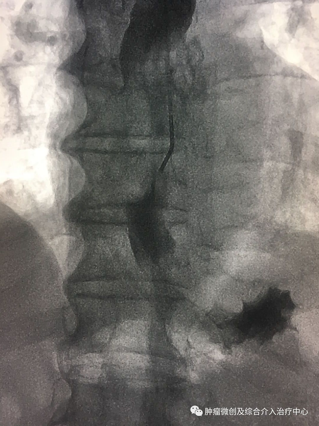 食道癌晚期介入治疗,山西肿瘤医院介入科食管癌