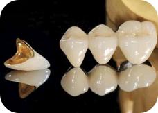 烤瓷牙的保修期是多长时间,烤瓷牙的保修期一般多久