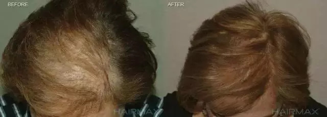 万事屋推荐|不想变秃的十二星座,这可能是目前为止世界上最有效的生发方案