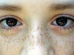 妊娠斑发病机制,妊娠斑是怎么引起来的