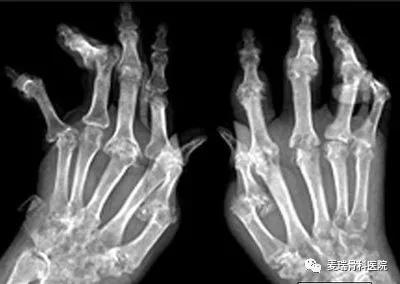 10年老类风湿如何根治,十年老类风湿用什么中成药效果好