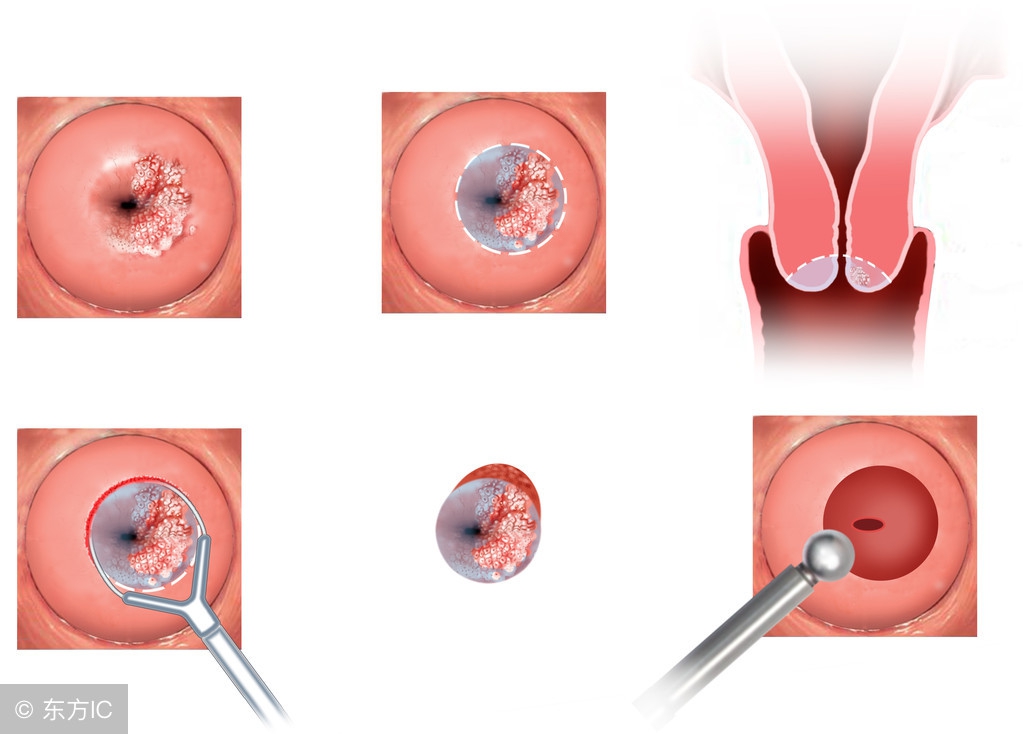 宫颈炎的症状有哪些可以用药吗,得了宫颈炎都有什么症状