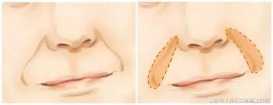 杨紫法令纹消除方法,女明星怎么解决法令纹的问题